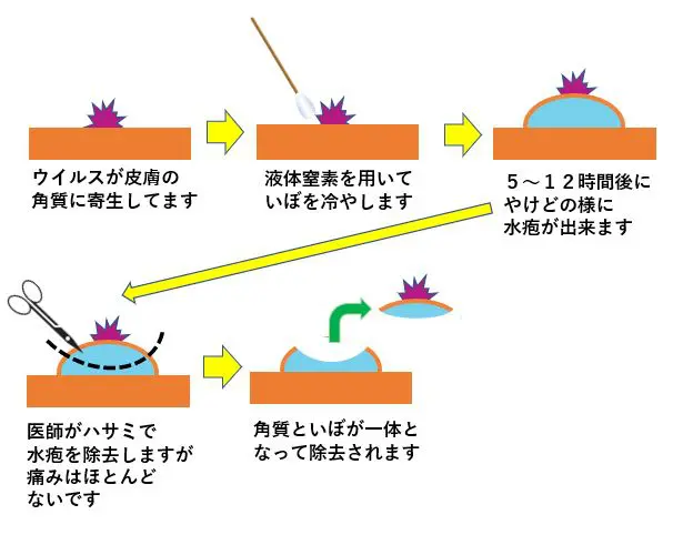 足裏の大きく治療困難なウイルス性いぼ 大和駅前皮フ科スキンクリニック